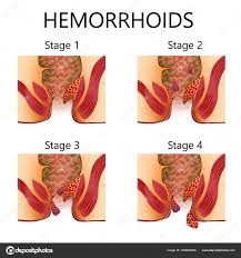 Can You Pop a Hemorrhoid? 2025