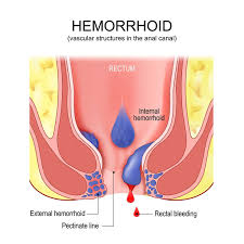 Can You Pop a Hemorrhoid? 2025