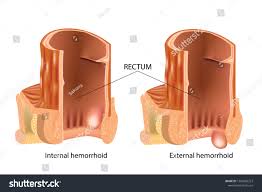 Can You Pop a Hemorrhoid? 2025